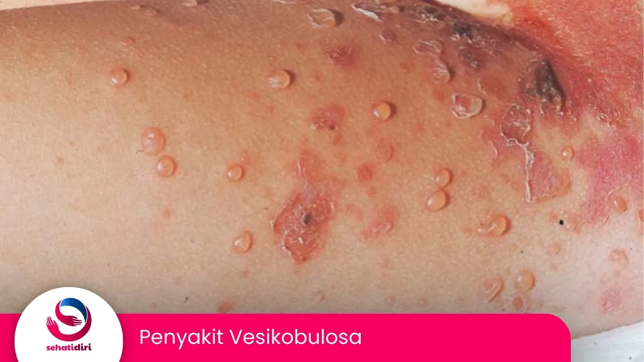 Penyakit Vesikobulosa