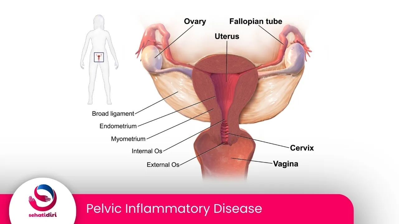 Pelvic Inflammatory Disease (PID)