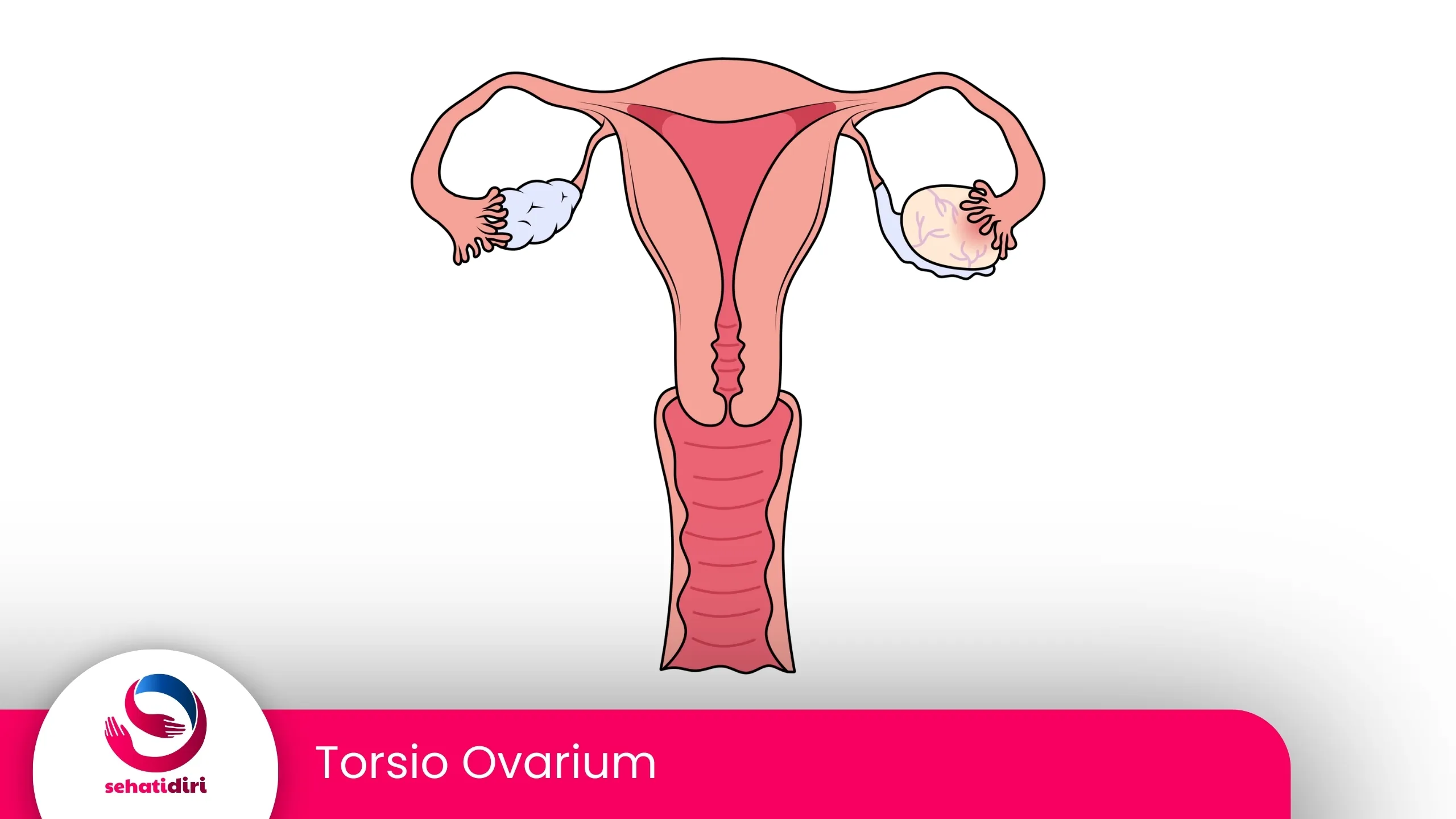 Torsio Ovarium