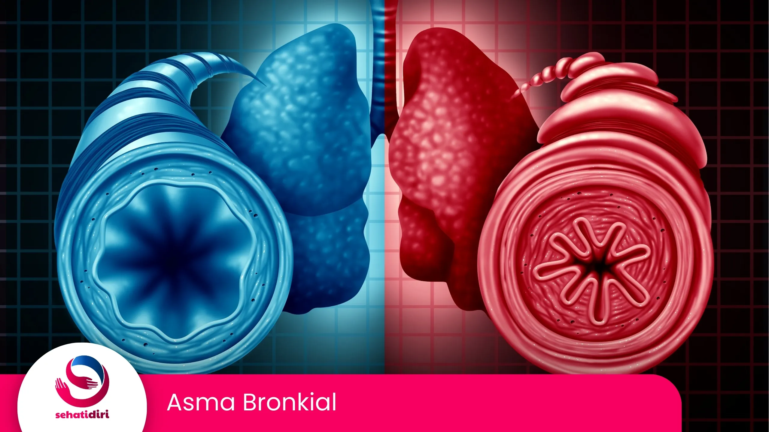 Asma Bronkial