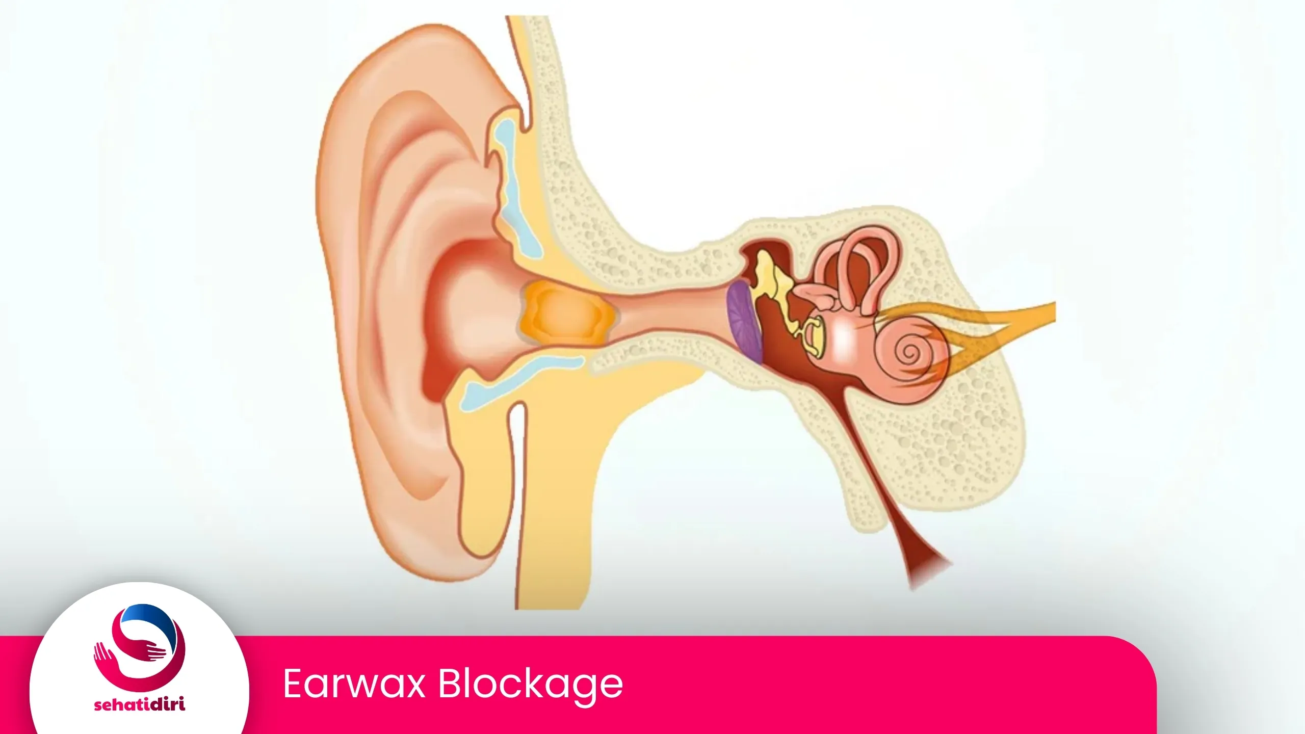Earwax Blockage