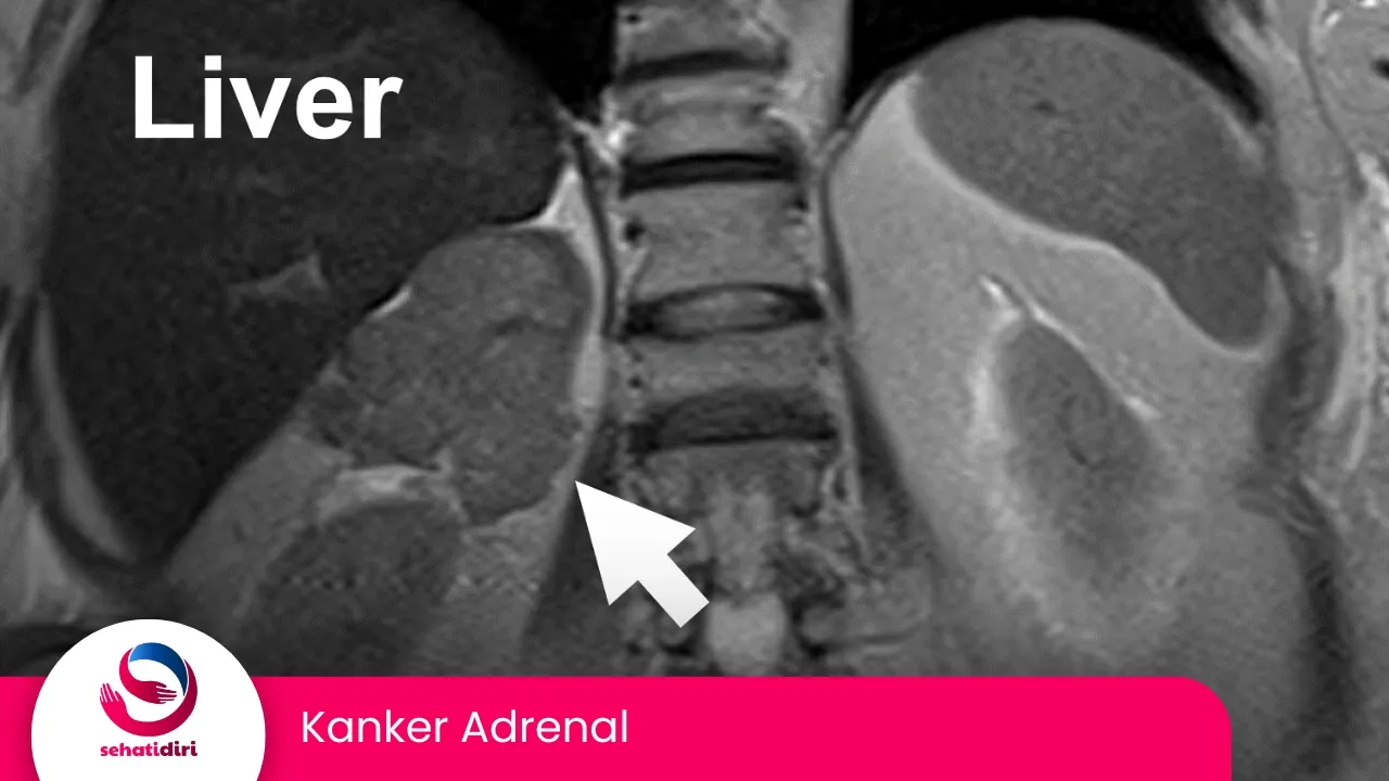 Kanker Adrenal